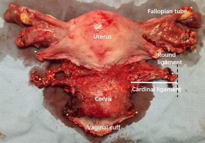 Evaluation of individualized para-tumor resection of cervical cancer patients based on three-dimensional reconstruction